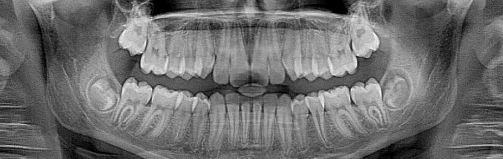 Digital X-Rays GT Dental Centre: Cosmetic and Family Dentist in Whitby | | GT Dental Centre: Cosmetic and Family Dentist in Whitby